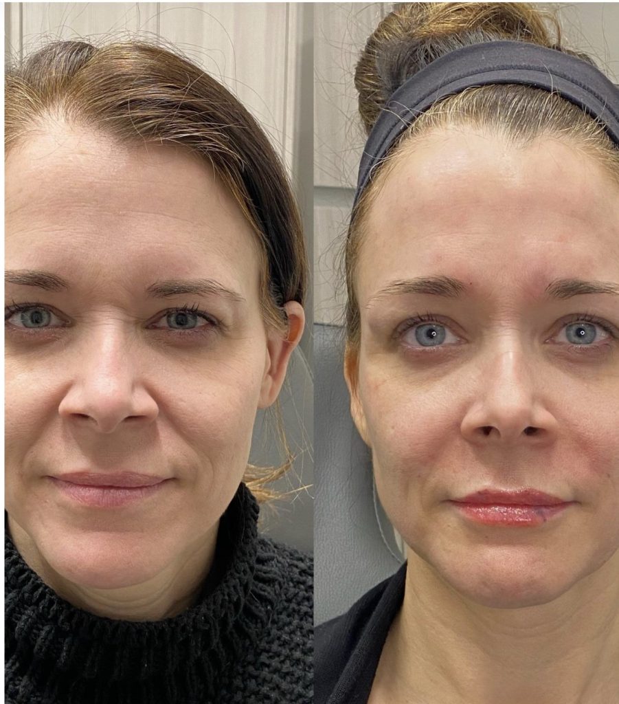 Before and after facial skin treatment at Aesthetic RX clinic.